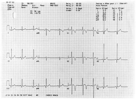 rvh with repolarization abnormality.